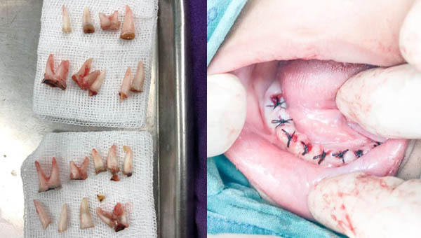 Cậu bé 4 tuổi phải nhổ 18 chiếc răng vì cha mẹ quên làm điều này