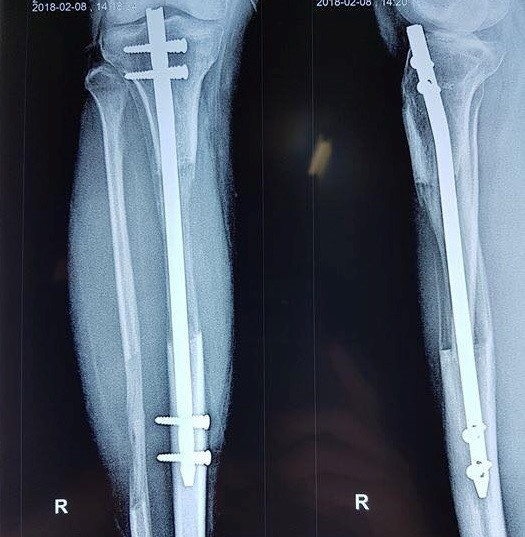 Vietnamese surgeons lengthen leg to 10 cm