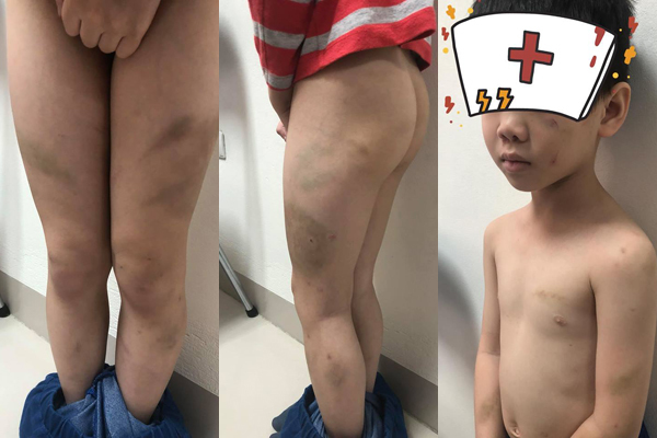 Nghi vấn bé 7 tuổi ở Hà Nội bị mẹ kế bạo hành: Cháu bé được đưa đi giám định