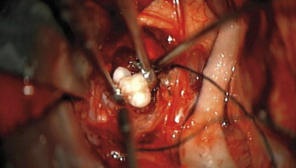 Khối u trong não cậu bé 4 tháng tuổi bất ngờ mọc răng