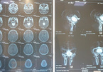 HCM City hospital does 15-hour brain surgery for grade-IV tumork