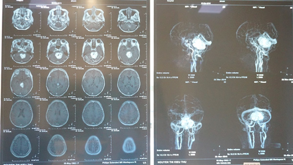 HCM City hospital does 15-hour brain surgery for grade-IV tumork
