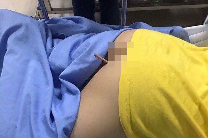 HS lớp 4 bị bút chì đâm xuyên mông 16 cm khi ngồi xuống ghế