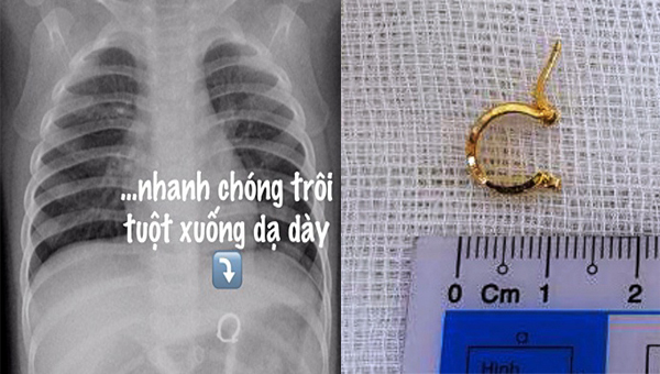 Chiếc khuyên tai vàng đi lạc suýt đâm thủng dạ dày bé gái 1 tuổi