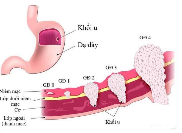 Người mẫu 8x qua đời ở tuổi 37 vì ung thư dạ dày, chuyên gia khuyến cáo gì?