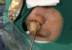 10 năm điếc ngửi, bác sĩ lôi ra thủ phạm chình ình trong mũi