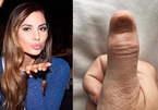 Hoa hậu 21 tuổi phát hiện ung thư nhờ dấu hiệu dễ bị bỏ qua trên ngón tay