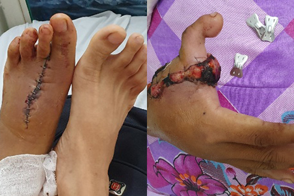 Cắt ngón chân ghép thành ngón tay cái cho bệnh nhân