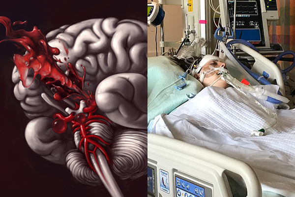 Thiếu nữ 15 tuổi bất ngờ đột quỵ, triệu chứng rất hay gặp ai cũng cần biết