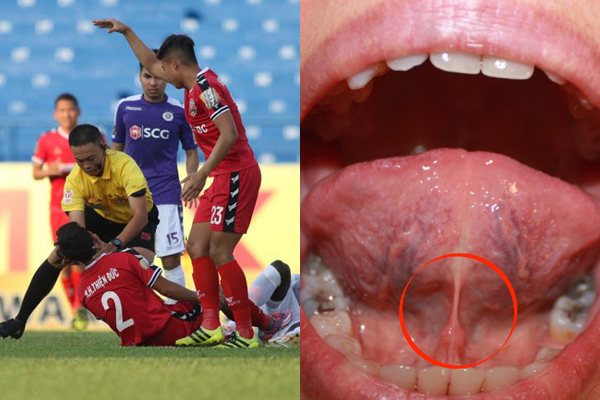 Cầu thủ Bình Dương bị ‘nuốt lưỡi’ sau cú va chạm, lưỡi có tụt vào trong?