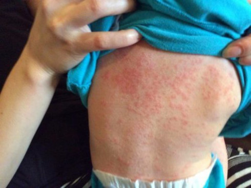 89 cases of measles recorded in Hanoi