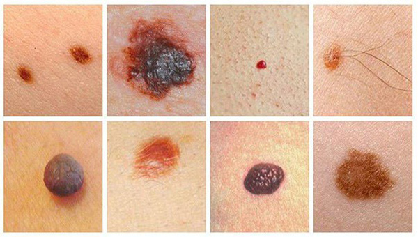 Chuyên gia chỉ ra sát thủ ung thư da từ nốt ruồi cực nguy hiểm
