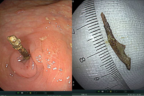 ‘Thủ phạm’ đi lạc 6 tháng trong người đàn ông mới được tìm thấy