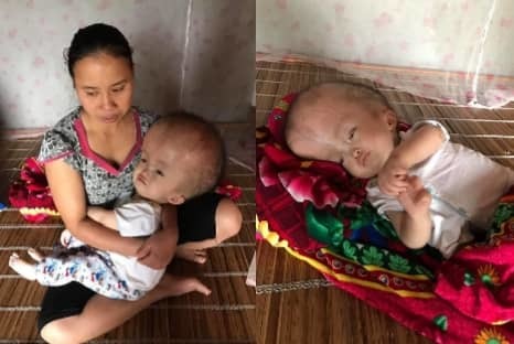 Rát lòng nghe bé trai não úng thủy khóc xuyên đêm trong căn nhà lá