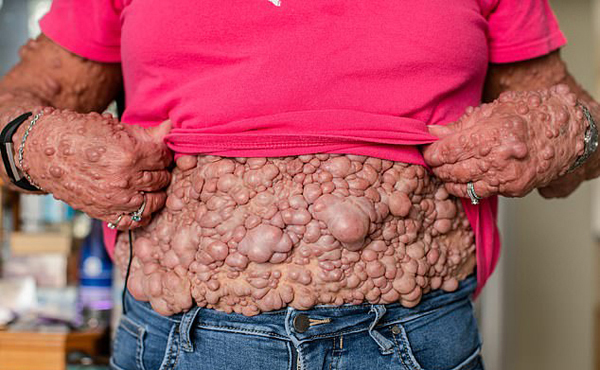 Người phụ nữ có hàng ngàn khối u mọc tua tủa trên người tìm được hạnh phúc