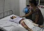 Tai nạn thương tâm: bé gái bị bỏng cồn cầu cứu