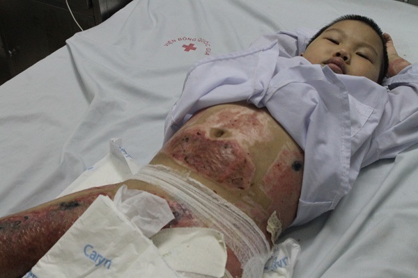 Tai nạn thương tâm: bé gái bị bỏng cồn cầu cứu