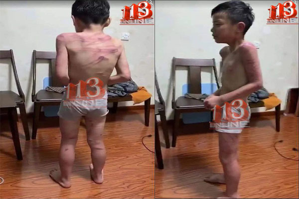 Cháu bé bị cha dượng đánh vằn lưng: Hình ảnh không phải ở Thanh Hóa