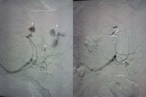 Nam bệnh nhân bị vỡ lá lách được cứu sống mà không cần phẫu thuật