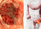 Bác sĩ cảnh báo 2 loại 'đau' báo hiệu ung thư ruột, 4 kiểu người nên đi khám sớm