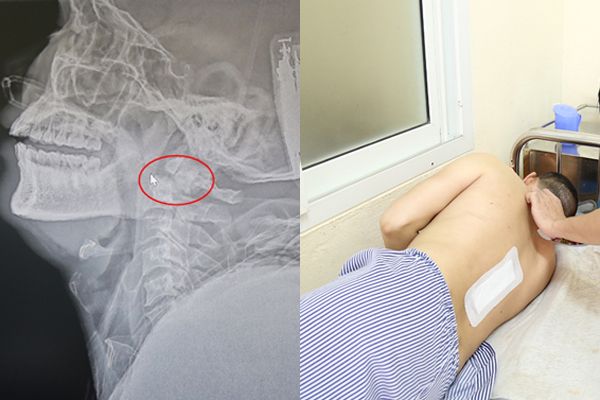 Người đàn ông Quảng Ninh bị liệt tứ chi, tưởng chết tại chỗ được cứu sống