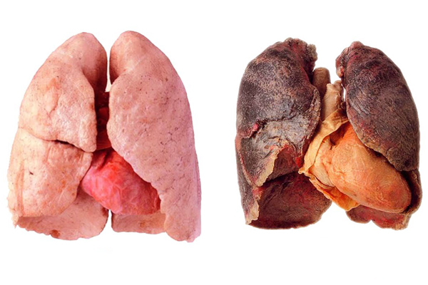 ‘Sát thủ’ 95 triệu người Việt tiếp xúc hàng ngày làm tăng 22 lần mắc ung thư phổi