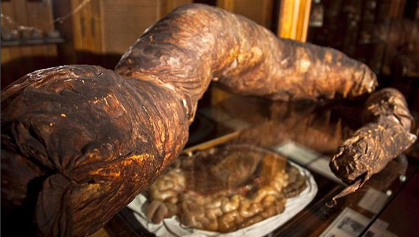 Người đàn ông chết khi đang đi vệ sinh, ruột được giữ ở bảo tàng mãi mãi