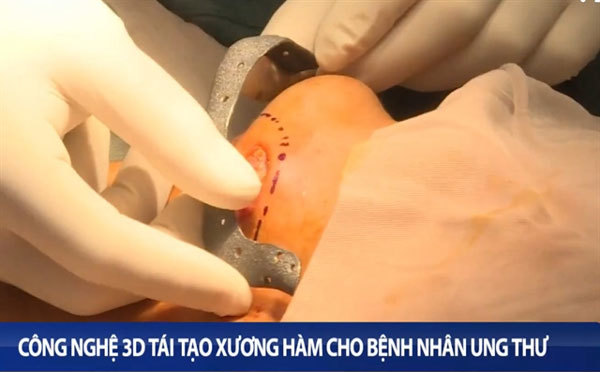 3D printing helps reconstruct jaws for cancer patients at HCM City hospital