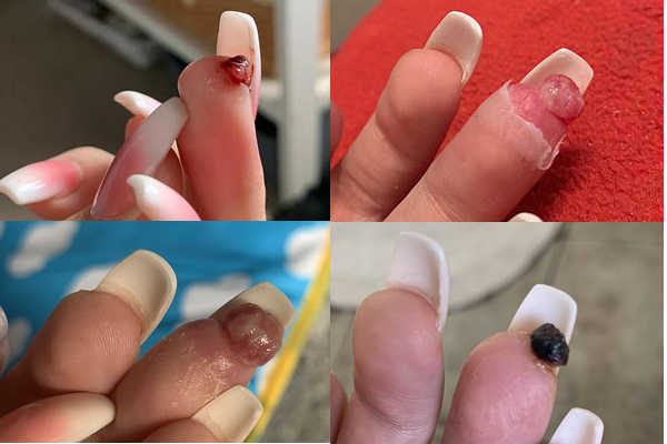 Cô gái trẻ suýt phải cắt cụt ngón tay vì điều ít để ý khi đi làm nail