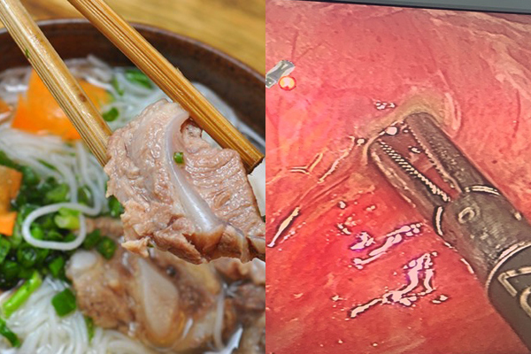 Ăn bún sườn quá nhanh, người phụ nữ Hà Nội bị thủng ruột