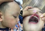Cô giáo tát bé 3 tuổi bầm mặt, tụ máu môi