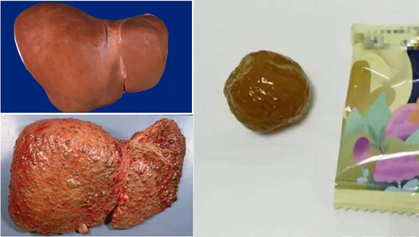 Giảm cân bằng cách ăn hoa quả sấy, người phụ nữ nhập viện vì xơ gan