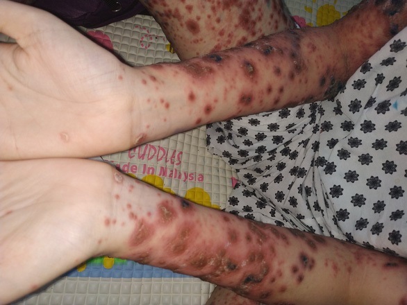 Bé gái Việt mang căn bệnh hiếm, cả thế giới chỉ có 38 trẻ mắc