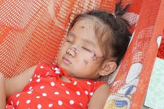 Bé gái 2 tuổi ở Tây Ninh bị chó hoang lao vào sân nhà cắn nát mặt