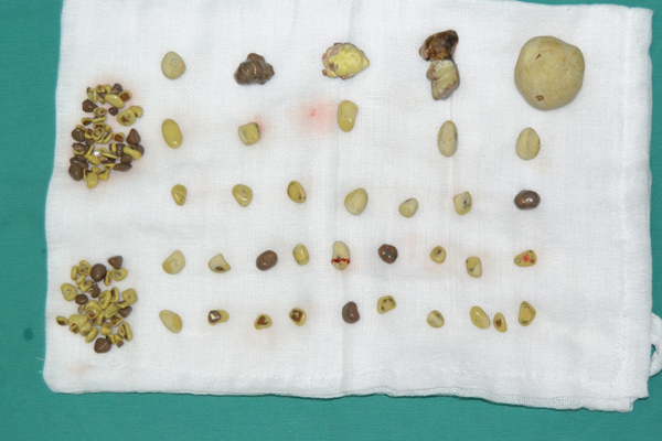 Đau thắt lưng kéo dài, bác sĩ nhặt ra 100 viên sỏi trong thận