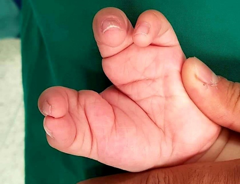 Phẫu thuật tạo hình bàn tay “càng cua” cho bé trai 2 tuổi ở Sài Gòn