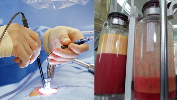 Người phụ nữ đi hút mỡ bụng rồi tử vong trên bàn mổ