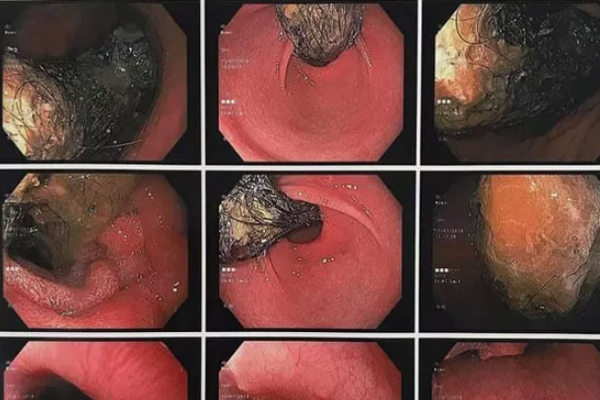 Cô bé 9 tuổi ở Thái Bình mắc hội chứng lạ, ăn tóc đến trụi đầu