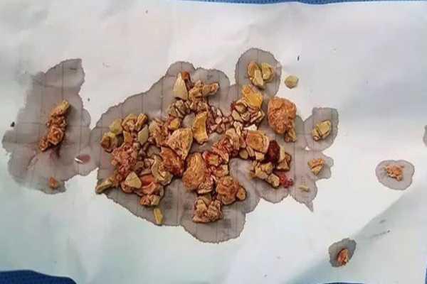 Đừng chủ quan, đau lưng âm ỉ cũng có thể tiểu ra sỏi