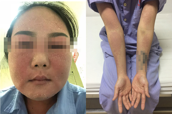 Bôi kem trắng da, cô gái Quảng Ninh phải nhập viện cấp cứu