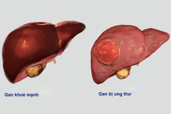 Ung thư gan VN xếp thứ 4 thế giới, những cách chữa mới nhất bệnh nhân cần biết