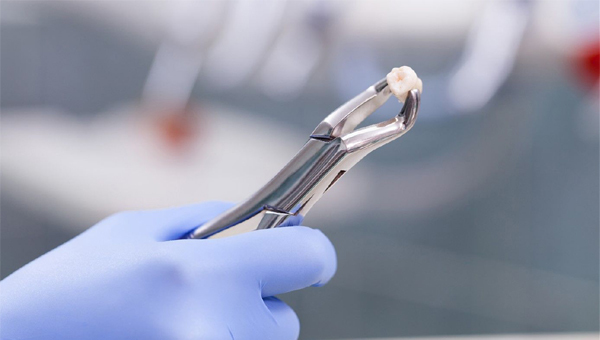 Cậu bé 7 tuổi bị đau miệng, đi khám bác sĩ bất ngờ nhổ bỏ 526 chiếc răng