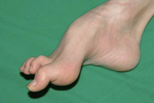 Hy hữu, chân cô bé Hà Nội gấp cong thành 3 khúc