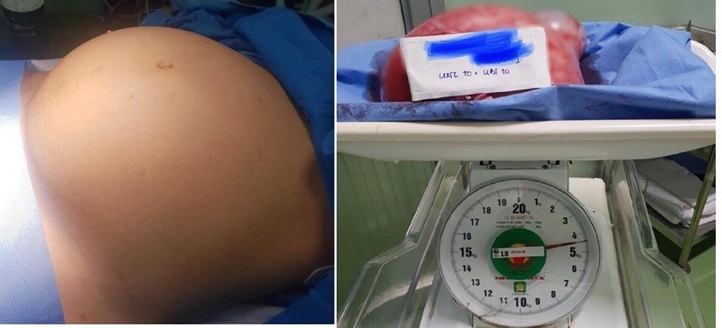 Tưởng béo phì ai ngờ mang khối u khủng 4,5kg trong bụng