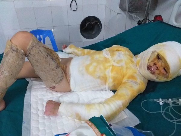 Xót thương bé gái bị bỏng cồn toàn thân nguy kịch tính mạng
