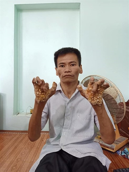 First 'tree man' in Vietnam