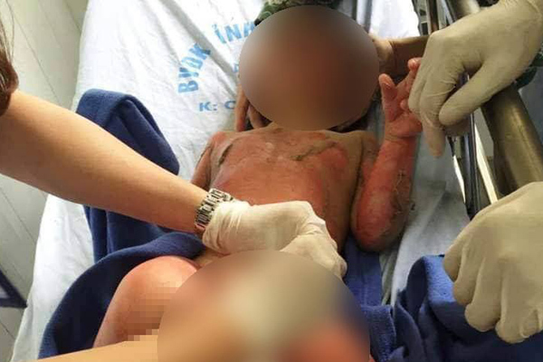 Vụ cô giáo đốt cồn dạy cháy nổ, 3 trẻ bị bỏng tiên lượng xấu