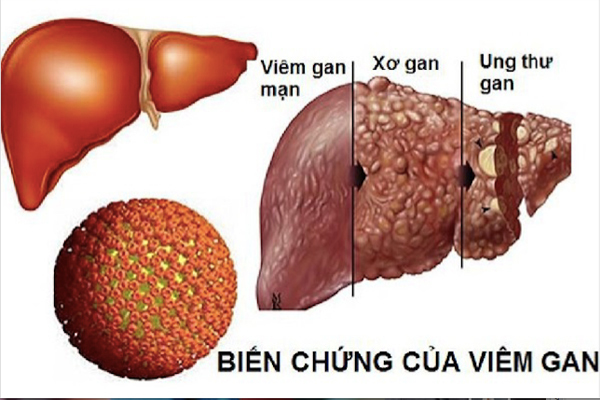 Viêm gan B, sát thủ thầm lặng gây ung thư gan phòng tránh thế nào cho hiệu quả