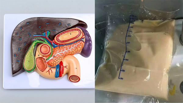 Người đàn ông 37 tuổi suýt tử vong vì viêm tụy, bác sĩ cảnh báo 6 điều cấm kỵ