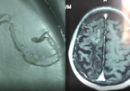 Người đàn ông đau đầu 30 năm, bác sĩ lôi ra sinh vật 10cm trong não